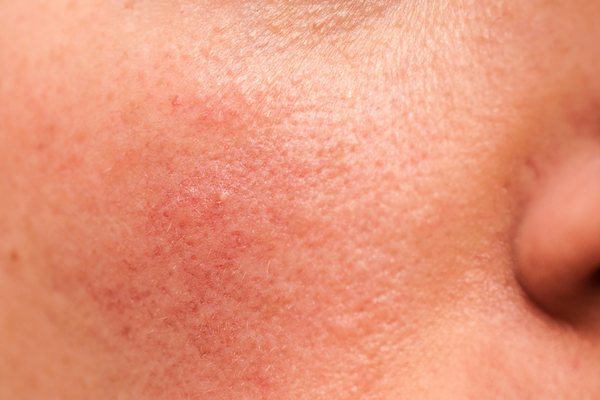 manage steroid-induced rosacea featured image