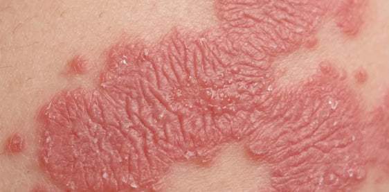 Dry, flaky eczema patches on skin