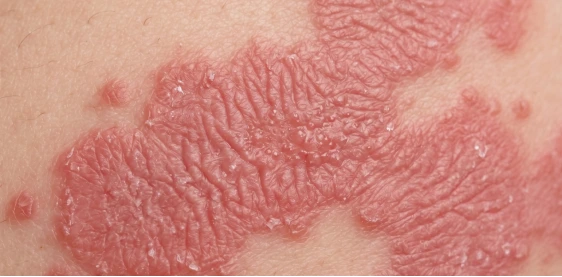 Eczema-affected dry skin close-up — Eczema & Dry Skin card