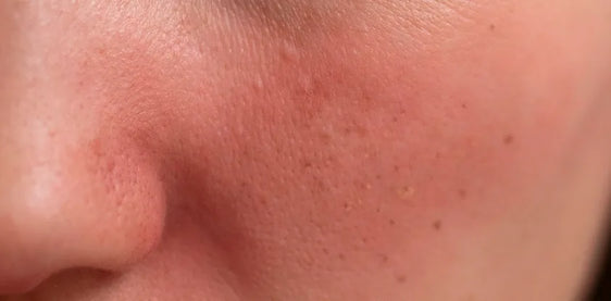 Redness on sensitive, reactive facial skin