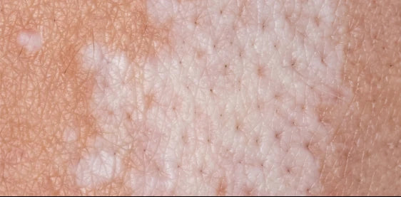 Gentle skincare applied to delicate, sensitive skin