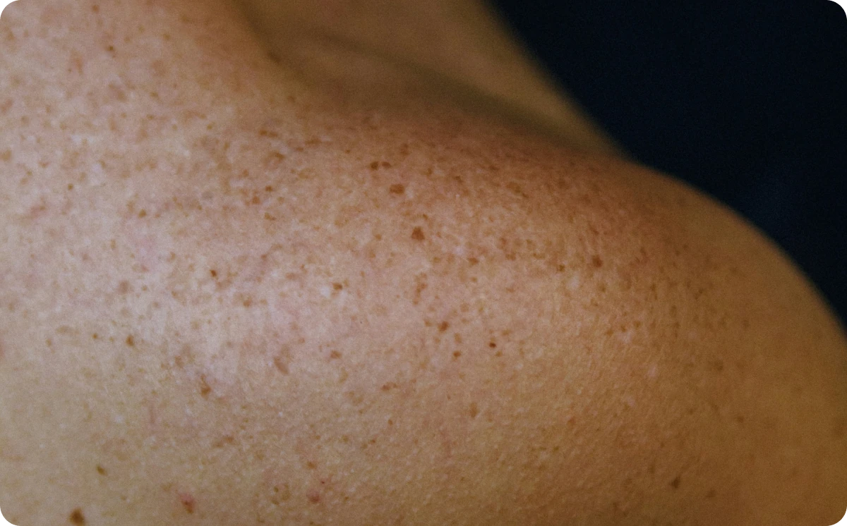 Close-up of bare skin across a shoulder