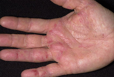 Emu Oil For Eczema