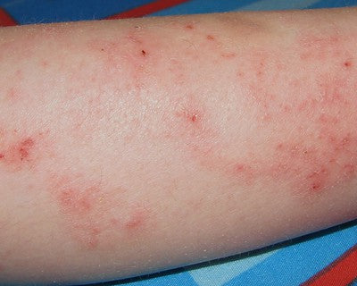 Eczema - Back of knees and legs