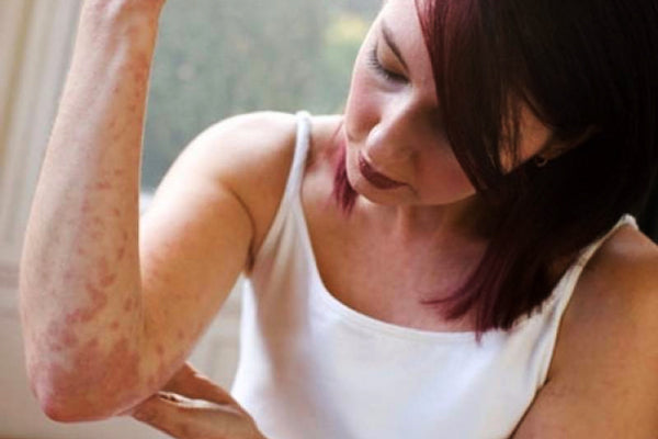 Eczema