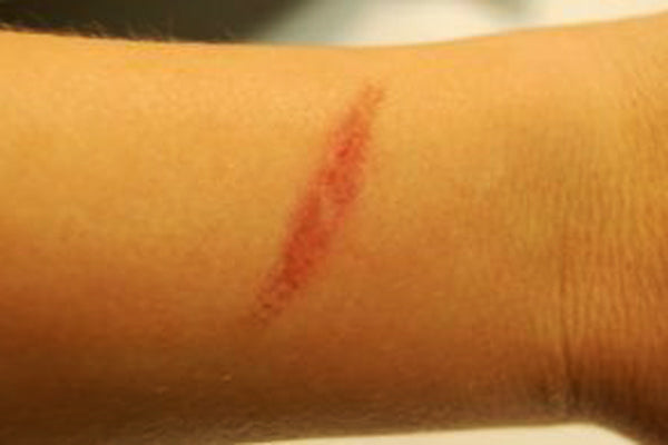 Using Emu Oil to Effectively Heal Burn Scars