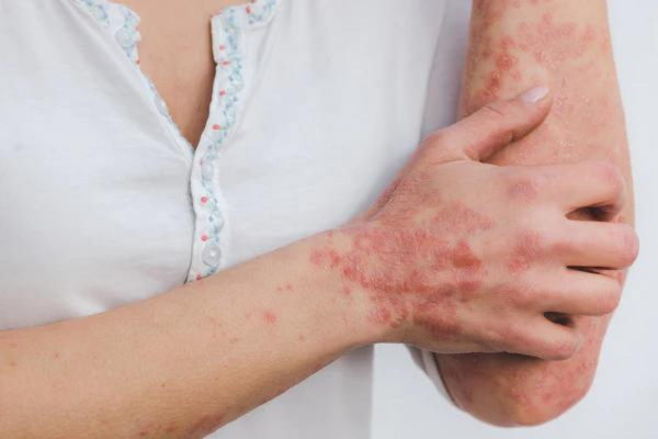 red skin syndrome relief featured image