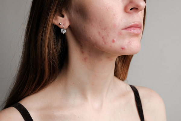 managing steroid-induced acne featured image