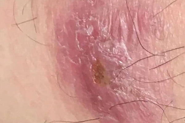Lichen sclerosus