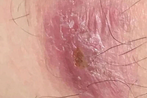 Lichen Sclerosus Et Atrophicus: Symptoms and Treatment | Emu Joy