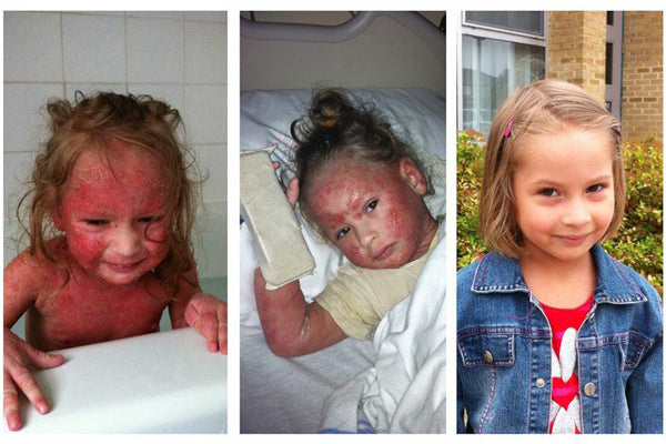 Red Skin Syndrome