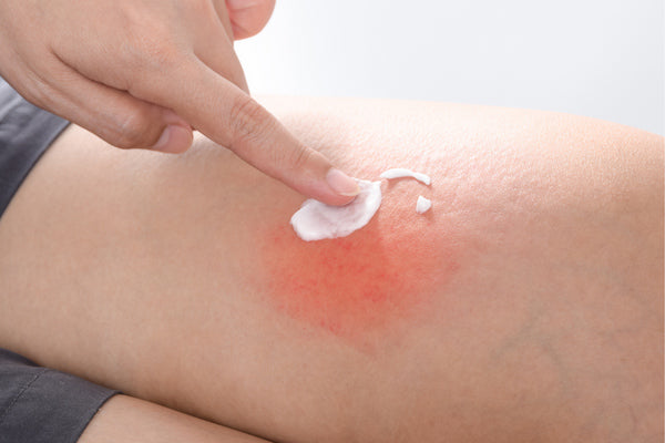 topical steroid dependence