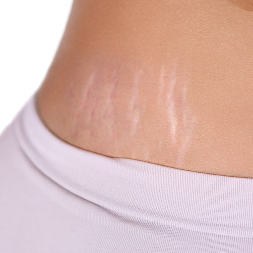 how to treat stretch marks