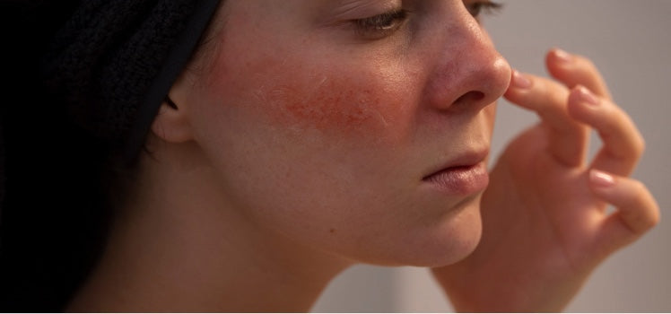 Woman with a patch of red, irritated skin across her cheek