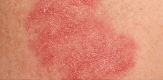 Irritated red patch on skin — Dermatitis card