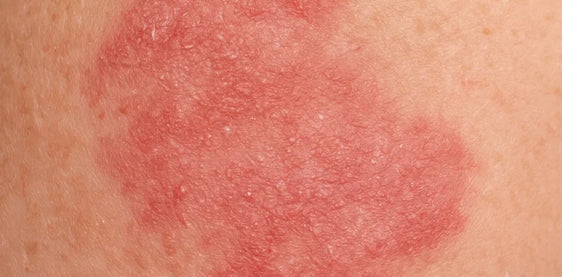 Red dermatitis rash on skin
