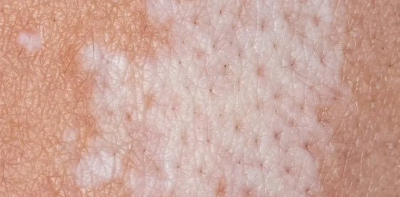 Pale patches of lichen sclerosus on skin