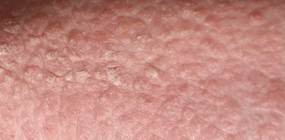 Scaly psoriasis plaque on skin