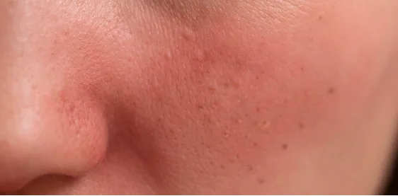 Close-up of a cheek and nose with redness and reactive, sensitive skin