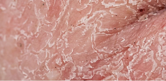 Skin recovering from topical steroid withdrawal — TSW card