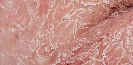 Flaking skin during topical steroid withdrawal