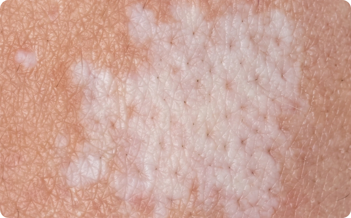 Close-up of skin with the pale patches of lichen sclerosus
