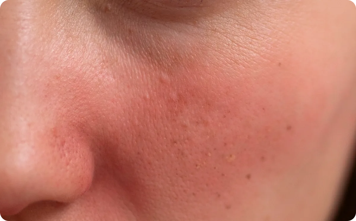 Close-up of reddened sensitive facial skin — Understanding section