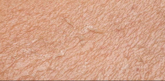 Close-up of severely dry, rough skin texture