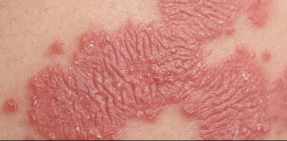 Close-up of inflamed, flare-prone skin on an arm