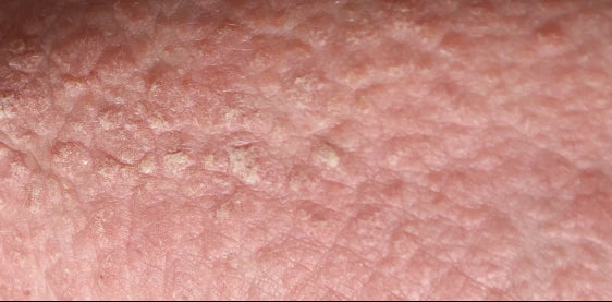Close-up of psoriasis plaques on skin