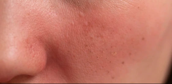 Woman with sensitive, easily irritated facial skin