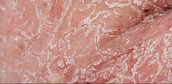 Reactive, red skin in recovery from topical steroid use
